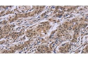 Immunohistochemistry of paraffin-embedded Human gastric cancer tissue using IPO8 Polyclonal Antibody at dilution 1:50 (Importin 8 antibody)