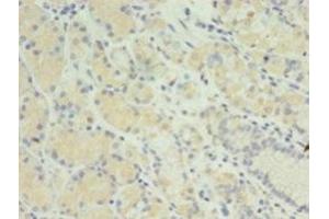 Immunohistochemistry of paraffin-embedded human gastric cancer using ABIN7165811 at dilution of 1:100