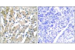 Immunohistochemistry analysis of paraffin-embedded human liver carcinoma tissue, using THRB Antibody. (THRB antibody  (AA 391-440))