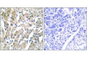 Immunohistochemistry analysis of paraffin-embedded human liver carcinoma tissue, using THRB Antibody. (THRB antibody  (AA 391-440))