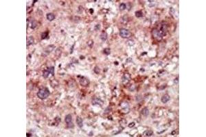 IHC analysis of FFPE human hepatocarcinoma stained with the GAK antibody (GAK antibody  (AA 15-45))