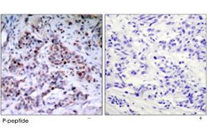 Immunohistochemical analysis of paraffin-embedded human breast carcinoma tissue using RELA (phospho T435) polyclonal antibody . (NF-kB p65 antibody  (pThr435))