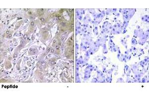 Immunohistochemistry analysis of paraffin-embedded human liver carcinoma tissue using ACOT12 polyclonal antibody .