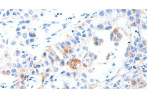 Immunohistochemistry of paraffin-embedded Human lung cancer tissue using MUC3A Polyclonal Antibody at dilution 1:60