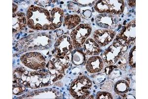 Immunohistochemical staining of paraffin-embedded Carcinoma of thyroid tissue using anti-RC219453 mouse monoclonal antibody.
