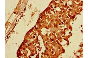 Immunohistochemistry of paraffin-embedded human breast cancer using ABIN7144480 at dilution of 1:100 (PPP1R13B antibody  (AA 375-675))