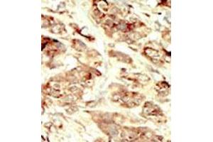 Formalin-fixed and paraffin-embedded human cancer tissue 8breast carcinoma) reacted with the primary antibody, which was peroxidase-conjugated to the secondary antibody, followed by DAB staining. (STK35 antibody  (Middle Region))