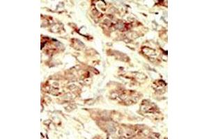 Formalin-fixed and paraffin-embedded human cancer tissue 8breast carcinoma) reacted with the primary antibody, which was peroxidase-conjugated to the secondary antibody, followed by DAB staining.