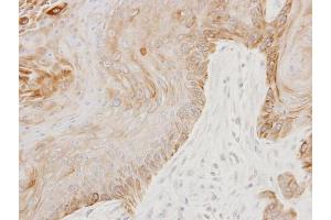 IHC-P Image Immunohistochemical analysis of paraffin-embedded Cal27 xenograft, using GGA3, antibody at 1:100 dilution. (GGA3 antibody  (C-Term))