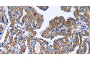 Immunohistochemistry of paraffin-embedded Human thyroid cancer tissue using IGSF10 Polyclonal Antibody at dilution 1:50 (IGSF10 antibody)