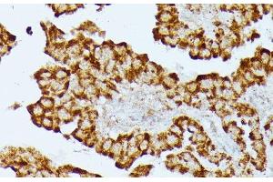 Immunohistochemistry of paraffin-embedded Human thyroid cancer using HMGCS2 Polyclonal Antibody at dilution of 1:100 (40x lens). (HMGCS2 antibody)