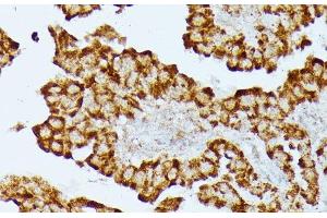 Immunohistochemistry of paraffin-embedded Human thyroid cancer using HMGCS2 Polyclonal Antibody at dilution of 1:100 (40x lens).