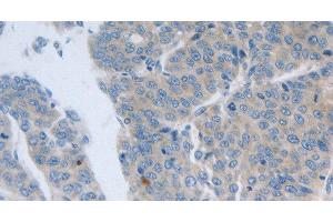 Immunohistochemistry of paraffin-embedded Human liver cancer tissue using GRIN1 Polyclonal Antibody at dilution 1:50 (GRIN1/NMDAR1 antibody)