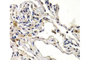 Immunohistochemistry of paraffin-embedded Human lung cancer using WNT3A Polyclonal Antibody at dilution of 1:200 (40x lens). (WNT3A antibody)