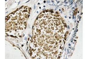 Immunohistochemistry analyzes of FosB antibody in paraffin-embedded human prostate carcinoma tissue. (FOSB antibody)