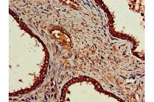 Immunohistochemistry of paraffin-embedded human prostate cancer using ABIN7161911 at dilution of 1:100 (NR5A2 + LRH1 antibody  (AA 182-291))