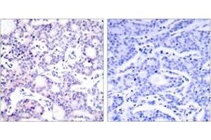 Immunohistochemistry analysis of paraffin-embedded human breast carcinoma tissue, using NF-kappaB p105/p50 (Ab-893) Antibody.