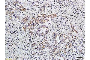 Formalin-fixed and paraffin embedded human colon carcinoma labeled with Anti-GNAQ/G?