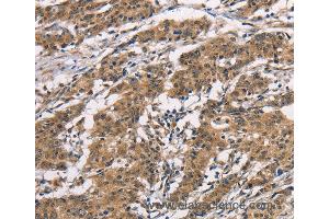 Immunohistochemistry of Human thyroid cancer using BAI1 Polyclonal Antibody at dilution of 1:40
