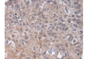 DAB staining on IHC-P; Samples: Human Lung cancer Tissue (HS2ST1 antibody  (AA 29-356))
