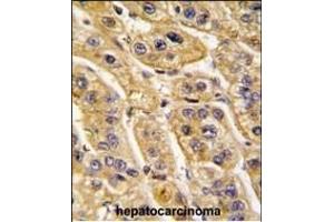 Formalin-fixed and paraffin-embedded human hepatocarcinoma tissue reacted with HIBCH antibody (Center), which was peroxidase-conjugated to the secondary antibody, followed by DAB staining. (HIBCH antibody  (AA 183-209))