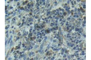 IHC-P analysis of Human Esophagus Cancer Tissue, with DAB staining. (IL1R1 antibody  (AA 21-109))