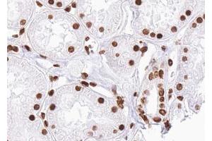 ABIN6267658 at 1/100 staining human kidney carcinoma tissue sections by IHC-P. (SMAD2 antibody  (pSer467))