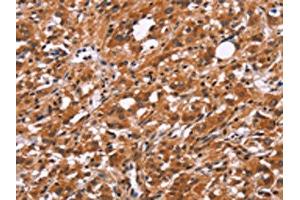 The image on the left is immunohistochemistry of paraffin-embedded Human thyroid cancer tissue using ABIN7192526(SLC8A2 Antibody) at dilution 1/15, on the right is treated with synthetic peptide. (SLC8A2 antibody)