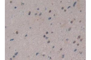 Detection of CIRBP in Human Glioma Tissue using Polyclonal Antibody to Cold Inducible RNA Binding Protein (CIRBP)