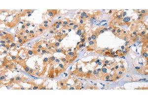 Immunohistochemistry of paraffin-embedded Human thyroid cancer tissue using BNIP3L Polyclonal Antibody at dilution 1:40 (BNIP3L/NIX antibody)