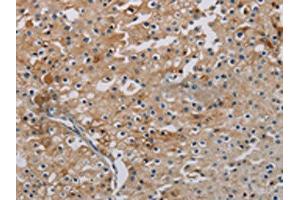 The image on the left is immunohistochemistry of paraffin-embedded Human prostate cancer tissue using ABIN7191864(PHKA2 Antibody) at dilution 1/30, on the right is treated with synthetic peptide. (PHKA2 antibody)