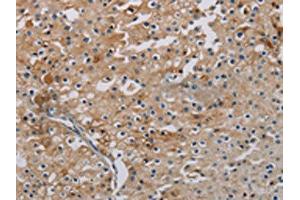 The image on the left is immunohistochemistry of paraffin-embedded Human prostate cancer tissue using ABIN7191864(PHKA2 Antibody) at dilution 1/30, on the right is treated with synthetic peptide.