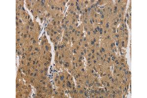 Immunohistochemistry of Human liver cancer using CKMT2 Polyclonal Antibody at dilution of 1:60