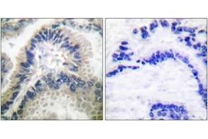 Immunohistochemistry analysis of paraffin-embedded human lung carcinoma tissue, using Guanylate Cyclase beta Antibody. (GUCYB antibody  (AA 10-59))