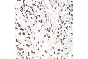 Immunohistochemistry of paraffin-embedded human kidney cancer using SOX5 antibody at dilution of 1:100 (x400 lens). (SOX5 antibody)