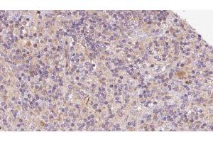 ABIN6273099 at 1/100 staining Human lymph cancer tissue by IHC-P. (CHCHD6 antibody  (Internal Region))