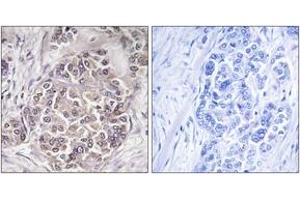 Immunohistochemistry analysis of paraffin-embedded human breast carcinoma tissue, using PEX1 Antibody.