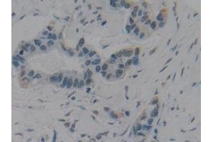 Detection of HMGB1 in Human Breast cancer Tissue using Polyclonal Antibody to High Mobility Group Protein 1 (HMGB1) (HMGB1 antibody  (AA 9-163))
