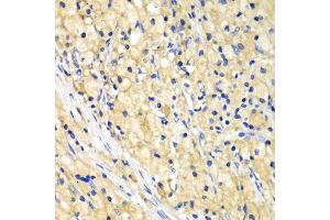 Immunohistochemistry of paraffin-embedded human lung cancer using NUP62 antibody. (NUP62 antibody  (AA 403-522))