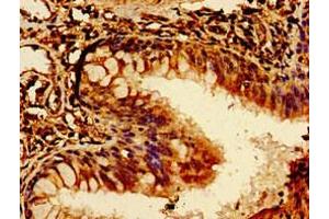 Immunohistochemistry of paraffin-embedded human lung cancer using ABIN7174072 at dilution of 1:100 (ROR2 antibody  (AA 752-926))