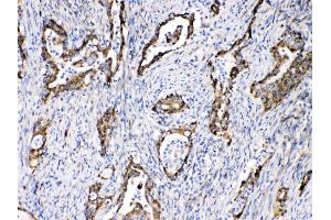 TECTA was detected in paraffin-embedded sections of human intetsinal cancer tissues using rabbit anti- TECTA Antigen Affinity purified polyclonal antibody (Catalog # ) at 1 µg/mL. (TECTA antibody  (N-Term))