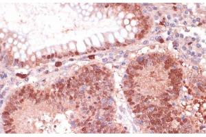 Immunohistochemistry of paraffin-embedded Human colon carcinoma using S100P Polyclonal Antibody at dilution of 1:100 (40x lens). (S100P antibody)