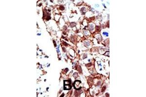 Formalin-fixed and paraffin-embedded human cancer tissue reacted with the primary antibody, which was peroxidase-conjugated to the secondary antibody, followed by AEC staining. (PIAS2 antibody  (C-Term))