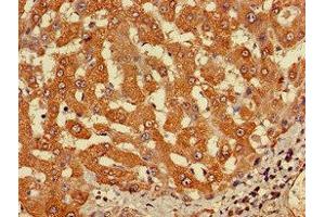 Immunohistochemistry of paraffin-embedded human liver cancer using ABIN7149214 at dilution of 1:100 (Cytochrome P450, Family 2, Subfamily A, Polypeptide 1 (CYP2A1) (AA 91-390) antibody)