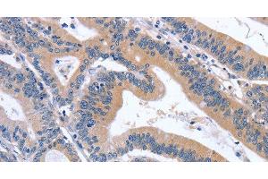 Immunohistochemistry of paraffin-embedded Human colon cancer tissue using GDF11 Polyclonal Antibody at dilution 1:30 (GDF11 antibody)