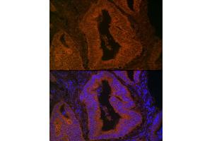 Immunofluorescence analysis of Human colon carcinoma using MYO5B antibody (ABIN6129305, ABIN6144287, ABIN6144288 and ABIN6224655) at dilution of 1:100. (MYO5B antibody  (AA 1440-1690))