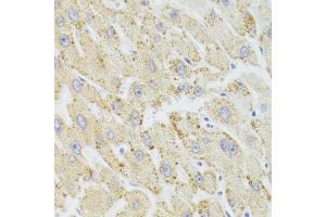 Immunohistochemistry of paraffin-embedded human liver injury using HSD17B13 Antibody. (HSD17B13 antibody  (AA 20-300))
