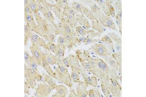 Immunohistochemistry of paraffin-embedded human liver injury using HSD17B13 Antibody.