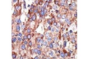 IHC analysis of FFPE human hepatocarcinoma tissue stained with the YY1 antibody (YY1 antibody  (AA 268-297))