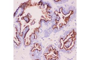Anti-MUC1 Picoband antibody,  IHC(P): Human Ovary Cancer Tissue (MUC1 antibody  (AA 935-1097))